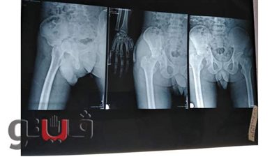 فريق طبي بمستشفى المنصورة الدولي يستبدل مفصل كامل الفخذ بآخر صناعي