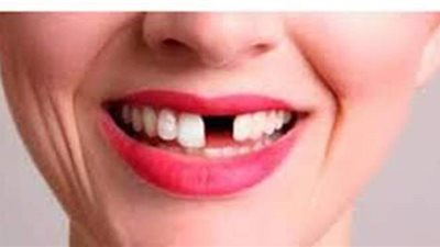 تفسير حلم سقوط الأسنان في المنام  للعزباء والمتزوجة والحامل