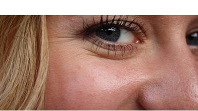 علاج تجاعيد العين