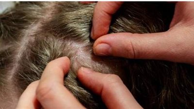 علاج القمل فى المنزل