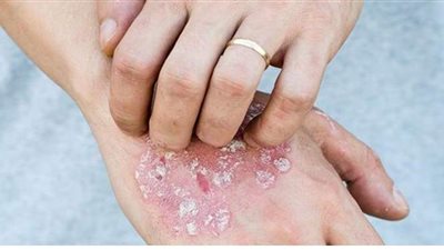 تعرف على أسباب مرض الصدفية وأعراضه وطرق الوقاية