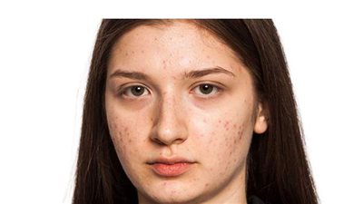 وصفة طبيعية للتخلص من حبوب الوجه في يوم واحد