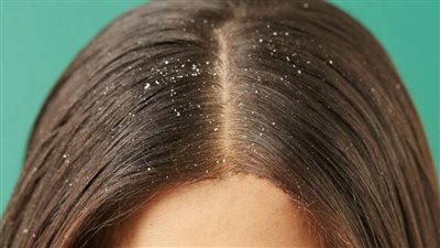 4 وصفات طبيعية لعلاج قشرة الشعر