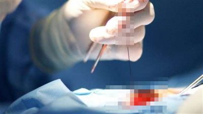 هل عملية التكميم الدقيق للمعدة لها آثار جانبية ؟ استشاري يُجيب