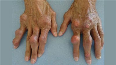 أسباب النقرس وأعراضه وطرق العلاج