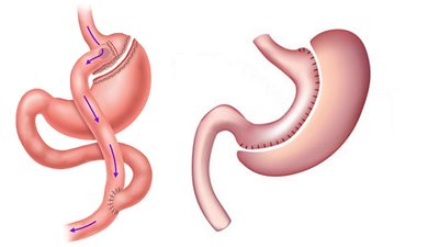 كيف يخطط الجراح لعملية السمنة ومتابعة نتائجها