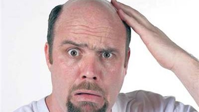 6 طرق تساعد على علاج الصلع الوراثي