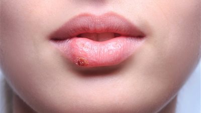 5 أعراض تؤكد إصابة طفلك بالـ