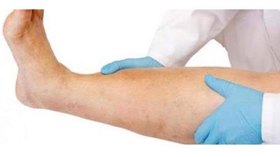 جلطة القدم .. الأسباب وطرق العلاج