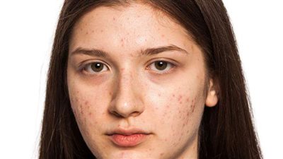 أسهل وأسرع 7 طرق لمواجهة حبوب الوجه والتخلص منها نهائيًا