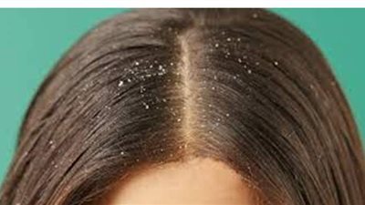 3 وصفات سريعة المفعول لعلاج القشرة في الشعر