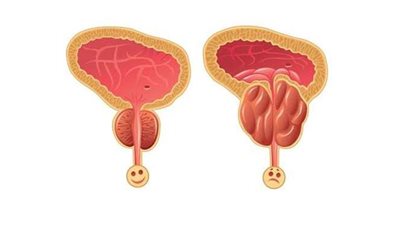 أدوية تزيد من أعراض الإصابة بتضخم البروستاتا احذرها