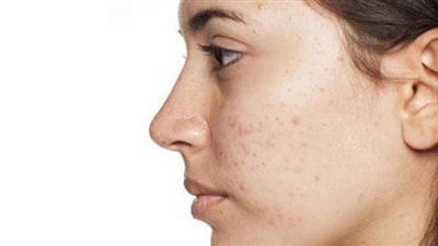 ٥ نصائح لمنع ظهور حبوب الوجه
