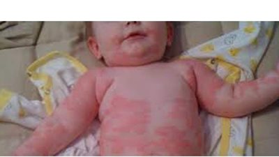 أعراض حساسية القمح