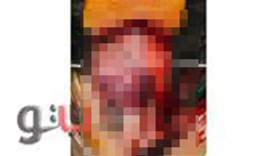 فريق طبي ينجح في إجراء جراحة قلب مفتوح لرضيعة بمستشفى المنصورة الدولي