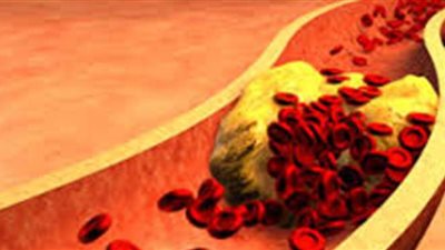 أعراض ارتفاع الكوليسترول