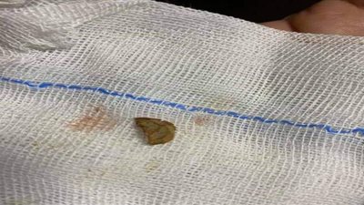 ظلت عالقة لـ ٣ أشهر.. استخراج قشرة فول سوداني من القصبة الهوائية لطفل ببنها