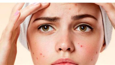 أفضل وصفة لعلاج حب الشباب في البشرة الدهنية