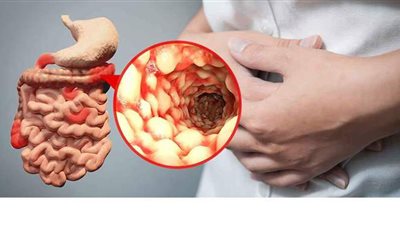 أعراض الإصابة بمرض كرون.. والنظام الغذائي طرق للعلاج