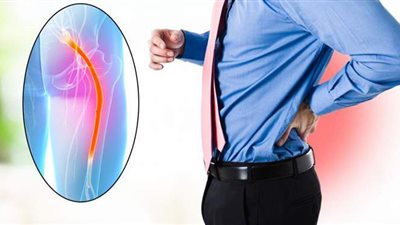 تعرف على أعراض عرق النسا.. وطرق العلاج