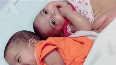 بعد طلاق والديهما.. لجنة الإغاثات الطبية تتولى فصل توأم بالدقهلية