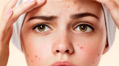 وصفة لإزالة حبوب الوجه في زمن قياسي وبأقل التكاليف