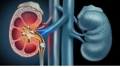 تعرف على أعراض حصى الكلى