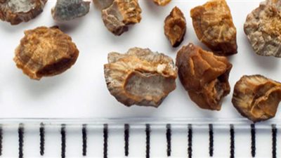 كل ما تريد معرفته عن حصوات الكلى.. أنواعها ومخاطرها وأسبابها