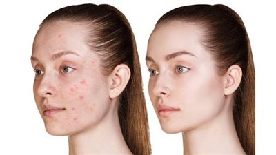 3 وصفات طبيعية لعلاج البثور والتخلص منها