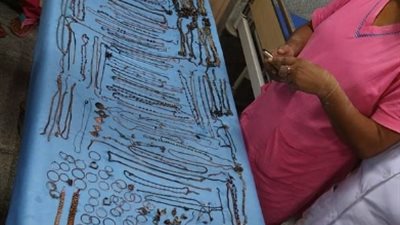 استخراج عشرات المجوهرات من معدة فتاة