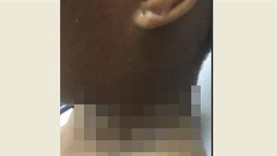 شاحن آيفون يترك فتاة بحروق من الدرجة الثانية في رقبتها