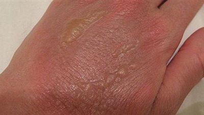 4 خطوات للتعامل مع حروق الجلد