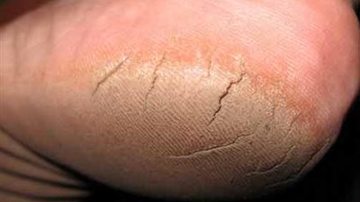 «الكركم والسكر البني وماء الأرز» ثلاثية التخلص من تشقق القدمين