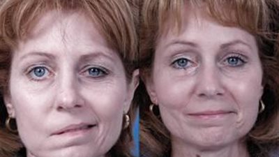 أسباب الإصابة بالتهاب «العصب السابع» وطرق العلاج