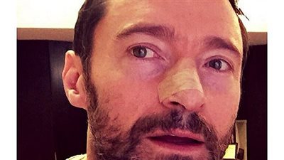 بالصور.. هيو جاكمان ينصح باستخدام كريمات واقية بعد علاجه من السرطان