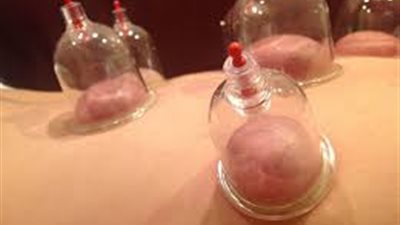 8 فوائد مدهشة للحجامة.. اكتشفيها