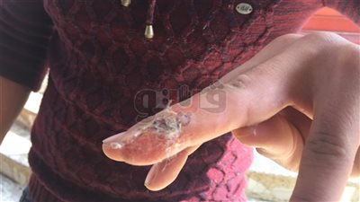 نشرة المحافظات.. ضحايا الطبيب المزيف بمستشفى دكرنس: «الخياطة سليمة»