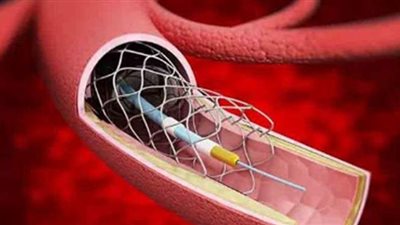 الدعامات الطرفية أفضل علاج لانسداد الشرايين الطرفية