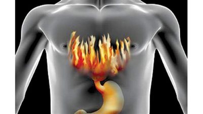 علاج ارتجاع المريء بالأعشاب