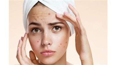 ٣ وصفات طبيعية لإزالة حبوب الوجه في يوم واحد