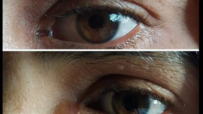 صحة الدقهلية: إجراء 175 عملية جراحية لمرضى العيون