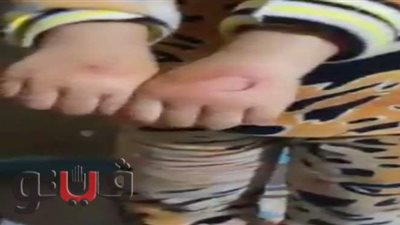 طفلة تروى تفاصيل واقعة حرقها داخل إحدى الحضانات | فيديو