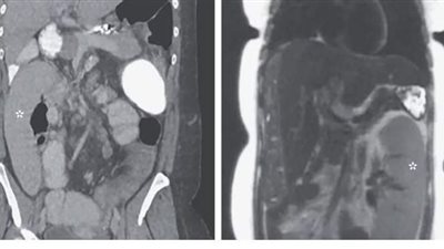 رجل بـ 3 كليات.. أغرب الحالات الطبية في 2020