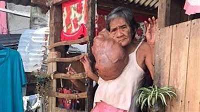 ورم ضخم في وجه امرأة يحرمها النوم (صور)