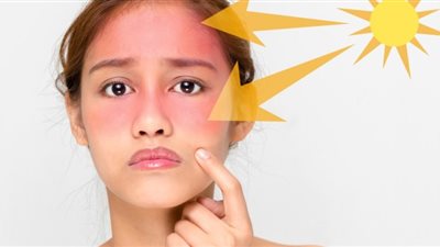 كيفية التخلص من حروق شمس الصيف