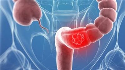 تعرف على الأعراض الرئيسية لسرطان الأمعاء