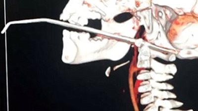 إبرة 14 سم تخترق وجه طفل يلهو بالصين (صور)