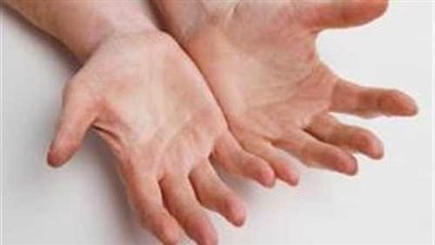 ضمور الأعصاب ينهش رءوس أبناء «اللقطوشة»