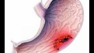 بالفيديو.. 6 علامات تكشف إصابتك بسرطان المعدة
