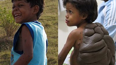 بالصور.. طفل بوحمة عملاقة على ظهره تشبه صدفة السلحفاة